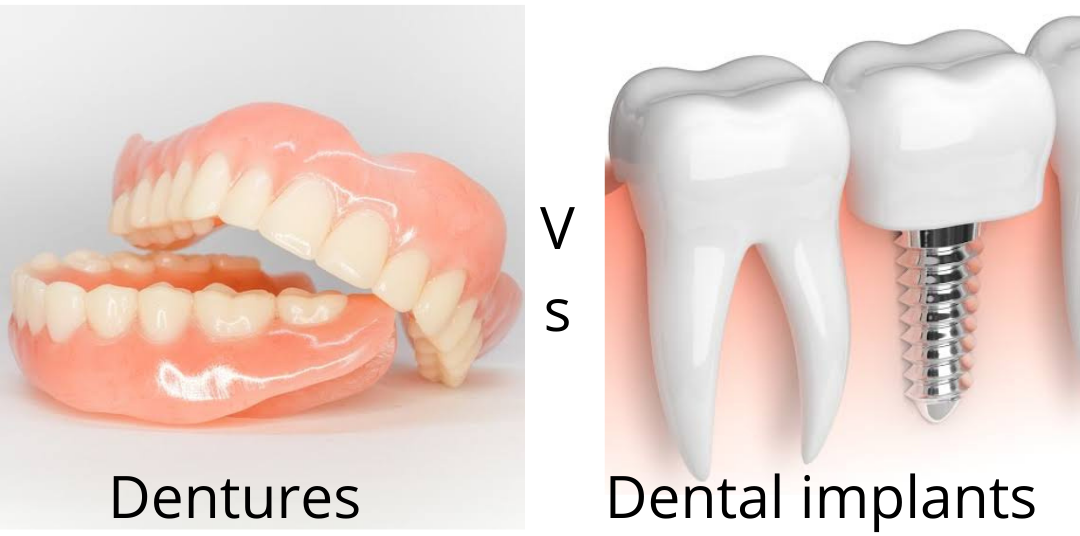 Denture vs Implants Dr. Akriti Dogra