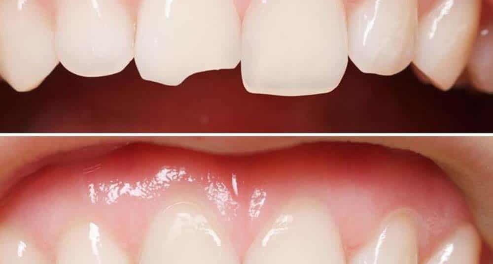 Dr. Akriti Dogra, Indodentist: Broken Tooth