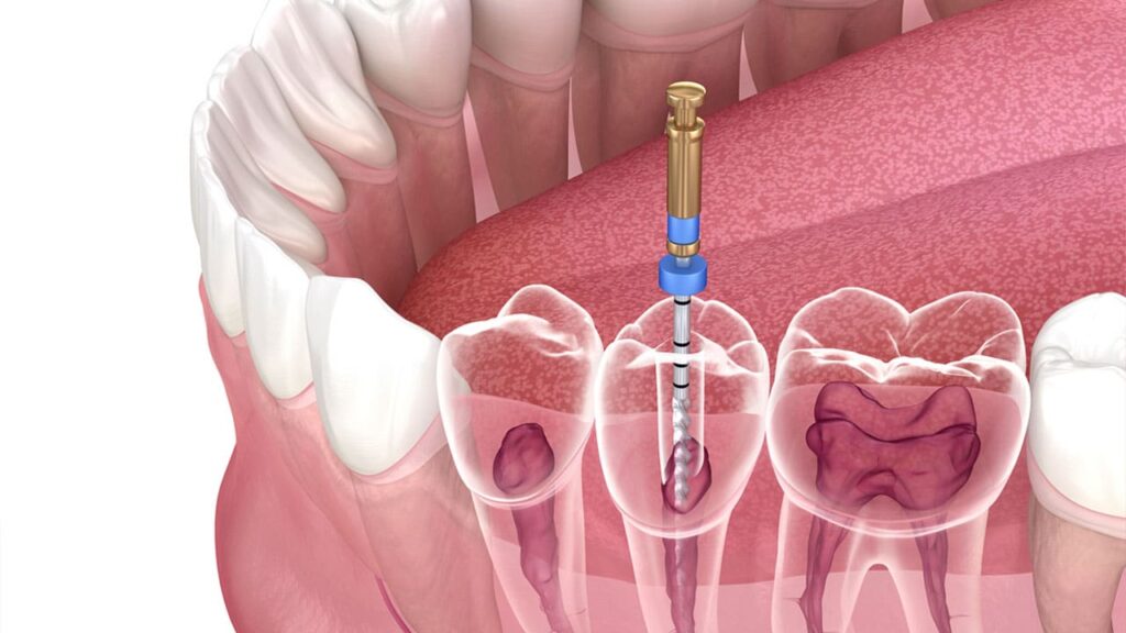 Dr. Akriti Dogra - Root Canal